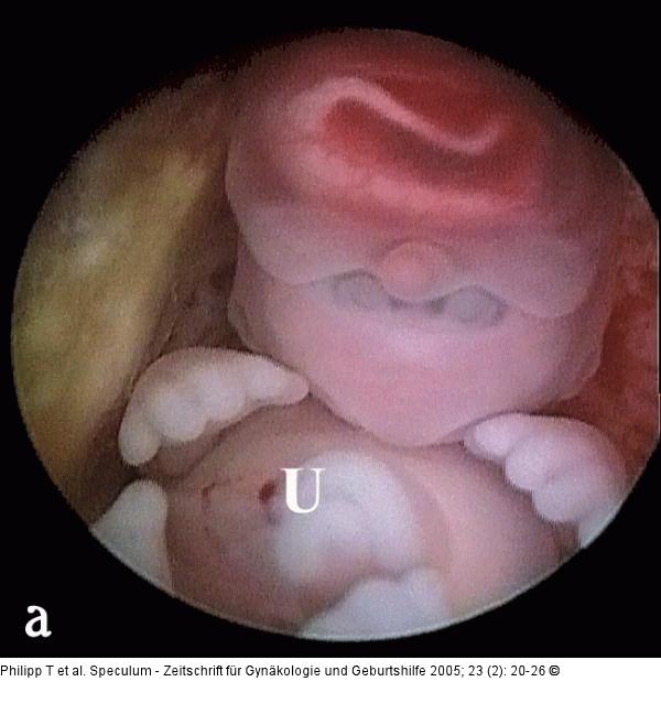 Triploider Embryo
