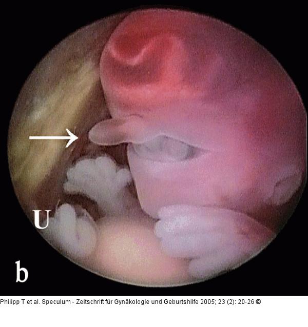 Triploider Embryo