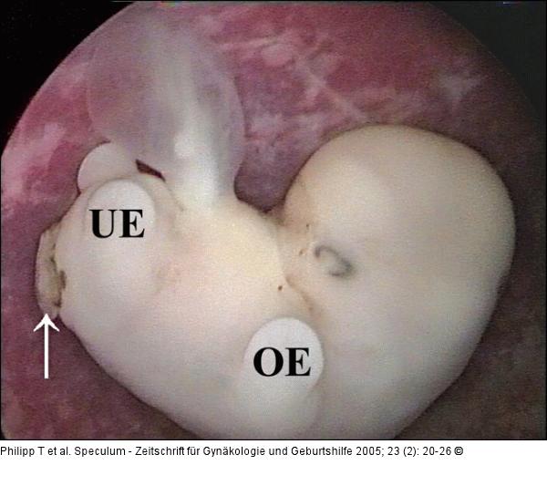 Triploider Embryo