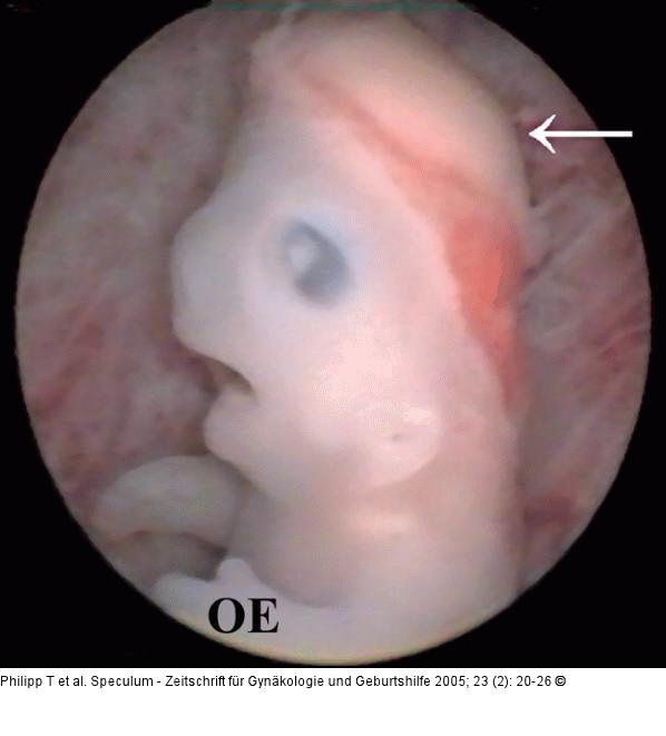 Embryo - Scheitel-Steißlage