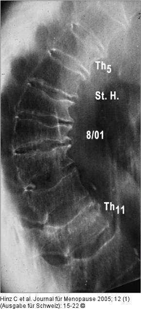 Osteoporose - Fallbeispiel