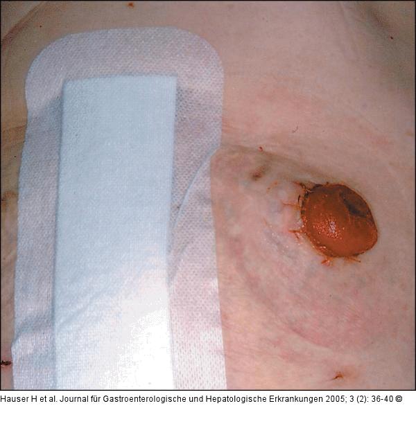 Stoma nach Rektumamputation