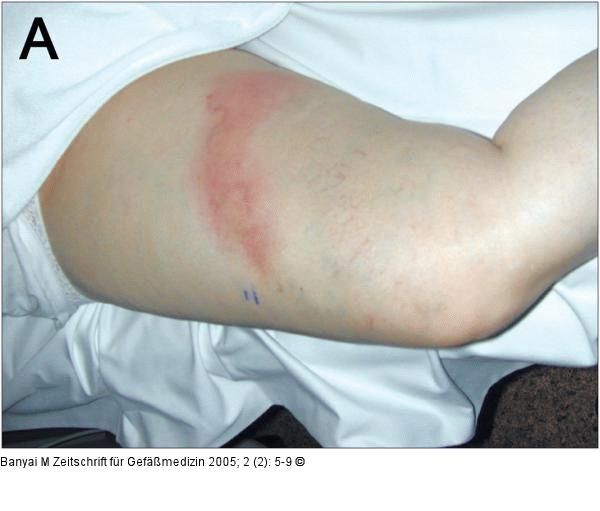 Varikophlebitis - Duplexsonographie