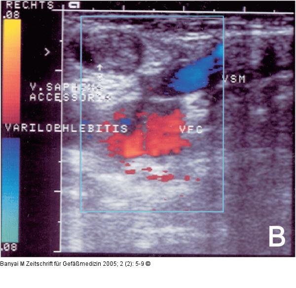 Varikophlebitis - Duplexsonographie