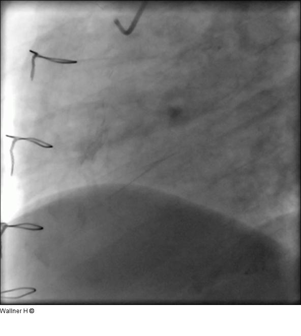 Saphena Vena Graft auf die rechte Kranzarterie (RAO 60°/0°)