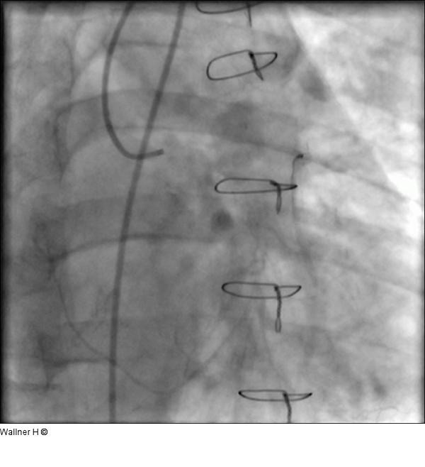 Saphena Vena Graft auf die Arteria circumflexa (RAO 60°/0°)