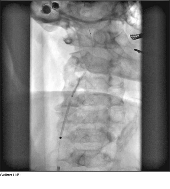 Open-cell-Nitinolstent