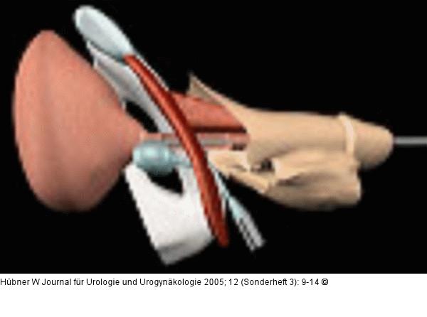 Pro-ACT-Verfahren