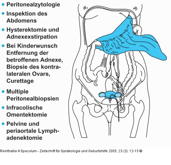 Ovarialkarzinom