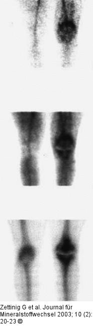 Osteomyelitis