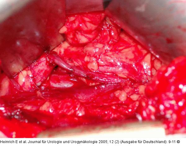 Ureterolyse