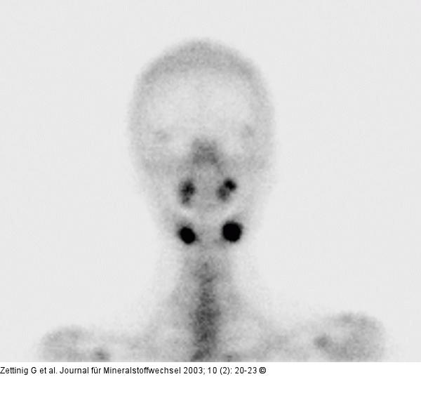 Osteomyelitis