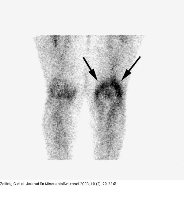 Osteomyelitis