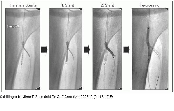 Crush-Stenting