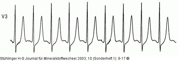 Hyperkaliämie - EKG