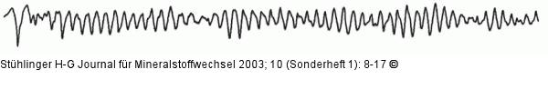 Torsade de pointes - EKG