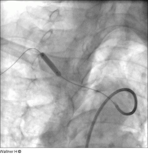 Vordilatation