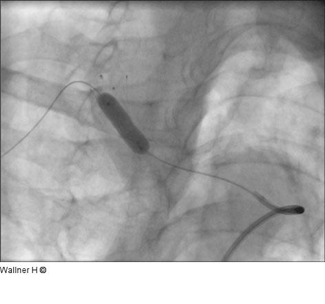 Postdilatation