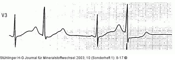 Neuroleptika, Trizyklika - EKG