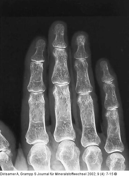 Osteoporose - Radiologie