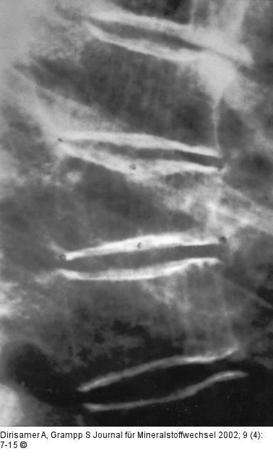 Osteoporose - Radiologie