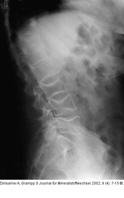 Osteoporose - Radiologie