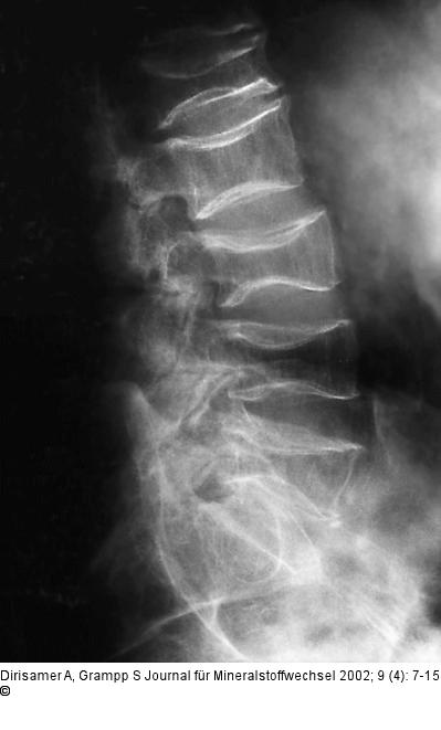 Osteoporose - Radiologie