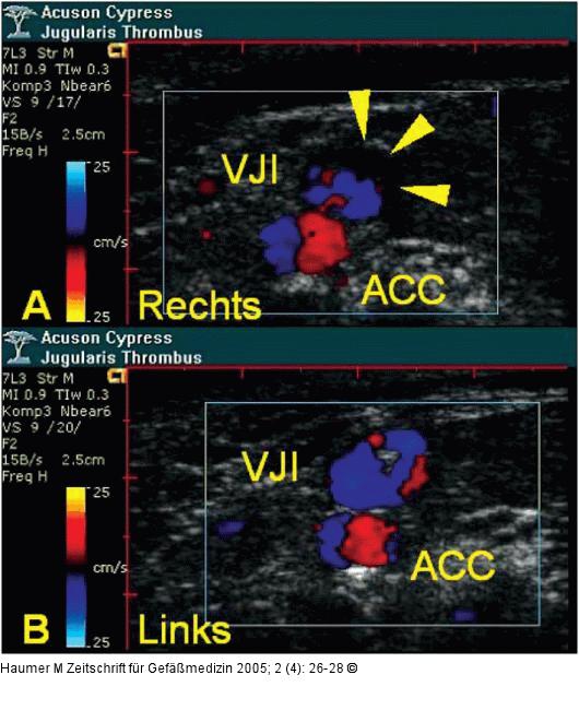 Vena jugularis - Thrombose