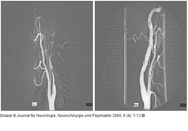 Arteria carotis interna - Trauma