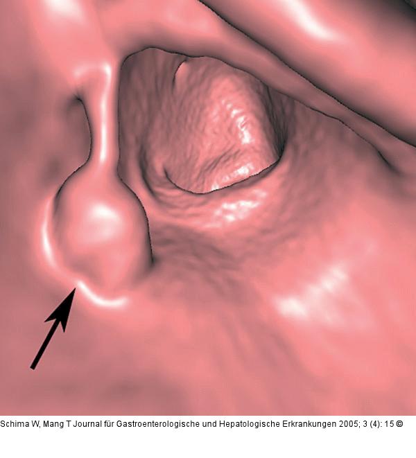 Colon sigmoideum - Polyp