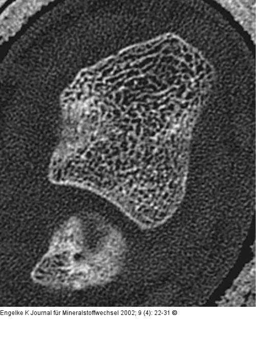 Densitometrie - Quantitative Computertomographie