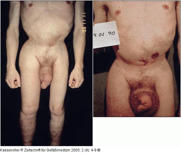 Fibrotisches Lymphödem
