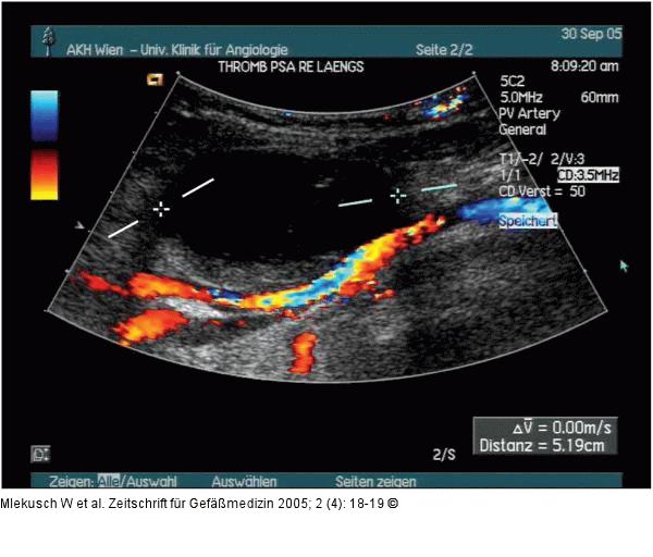 Sonographische Verlaufskontrolle