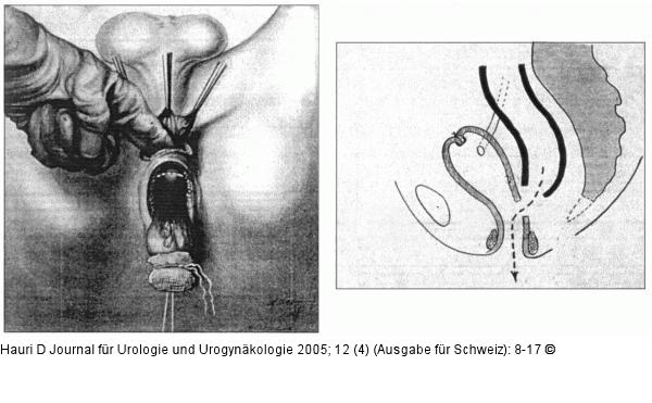 Rektumblase - Heitz-Boyer