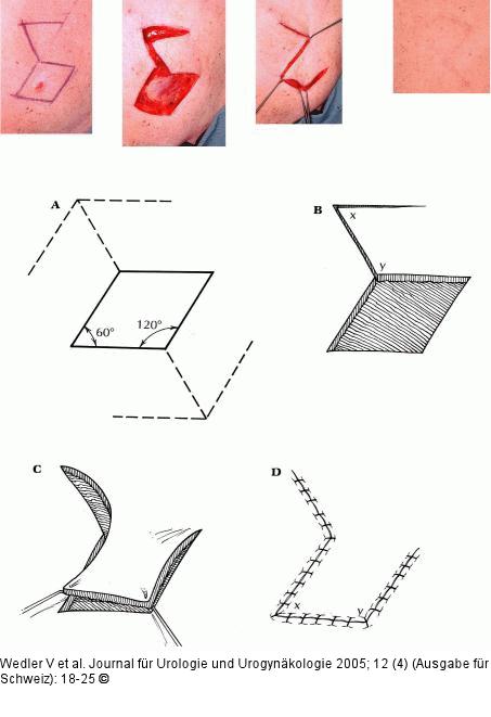 Random Flap - Limberg-Lappen