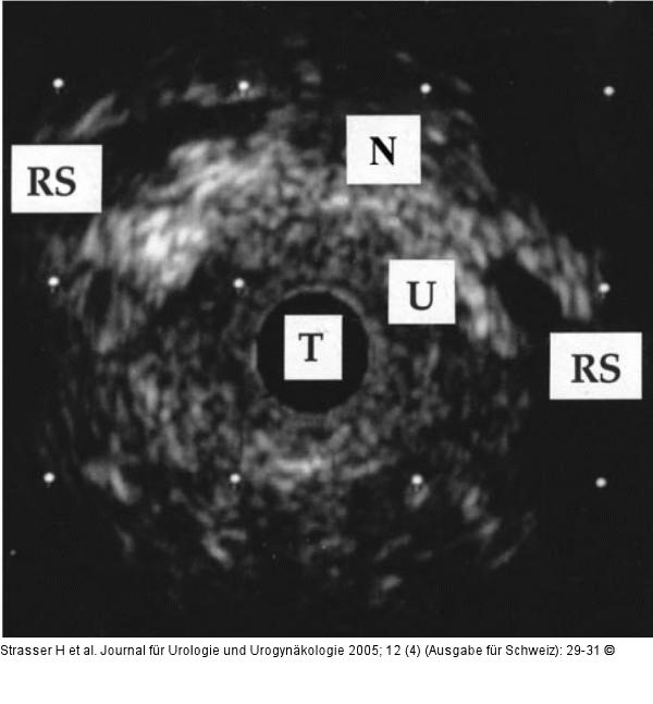 Transurethrale Sonographie