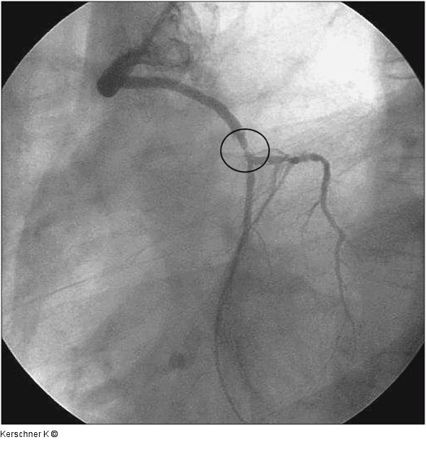 Aortokoronarer Venenbypass - LAO-Projektion
