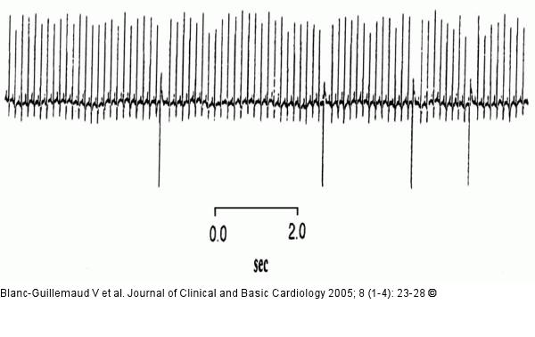 ECG - PMI5 group.