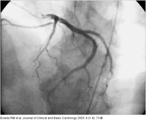 Coronary angiography