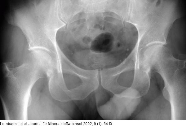 Osteoporose - Becken