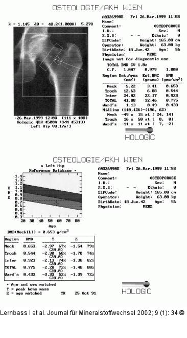 Osteoporose - Femur - DXA