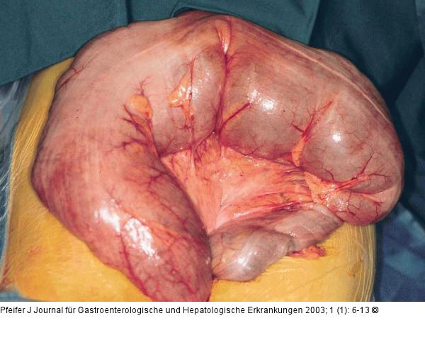 Sigmavolvulus