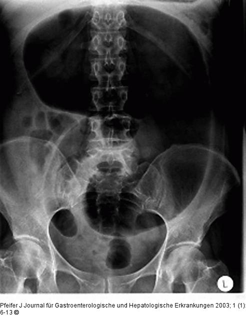 Sigmavolvulus