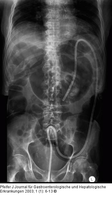 Sigmavolvulus