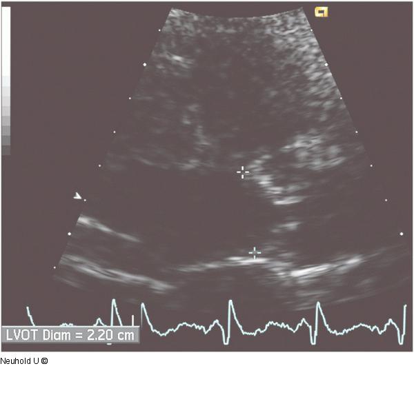 LVOT-Diameter