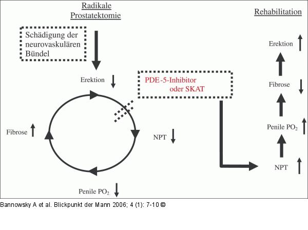 Radikale Prostatektomie - Rehabilitation