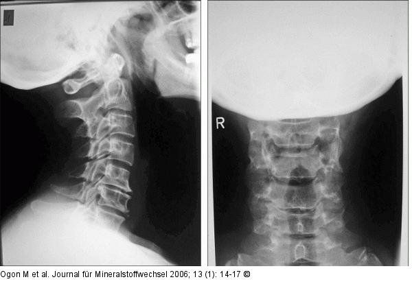 Spondylose C5/6