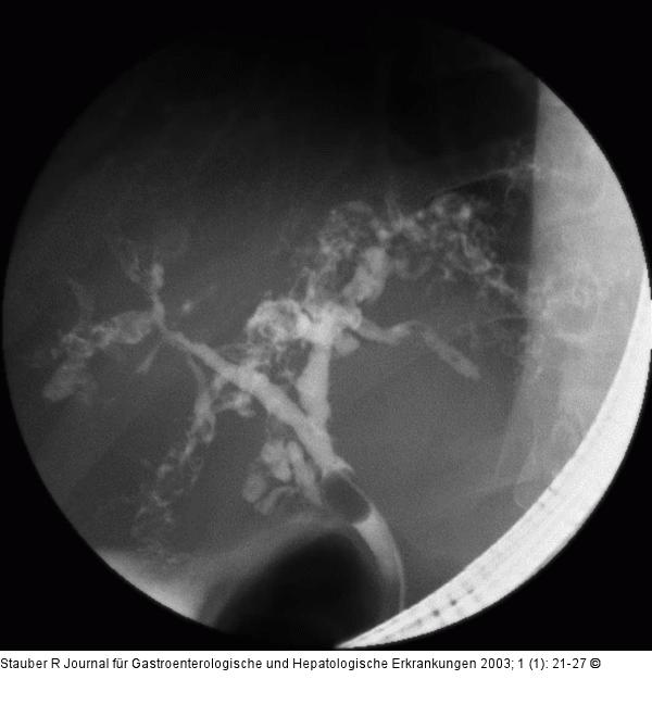 Primärsklerosierende Cholangitis