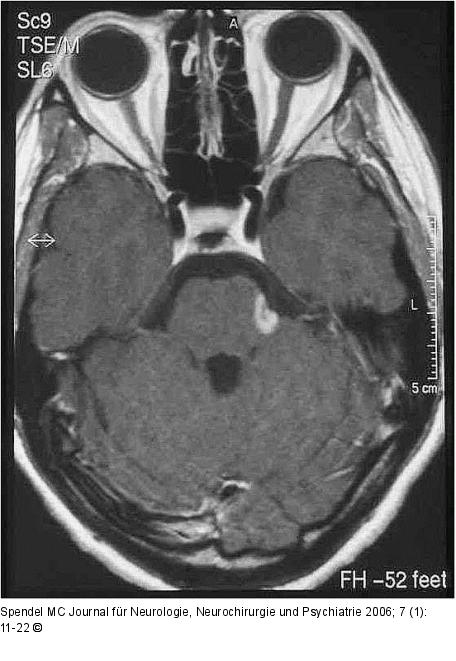 Enzephalitischer Plaque - Nervus trigeminus