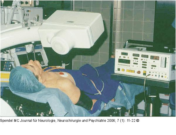 Thermokoagulation